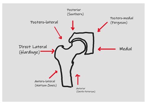 Surgical Approaches for Total Hip Arthroplasty. .